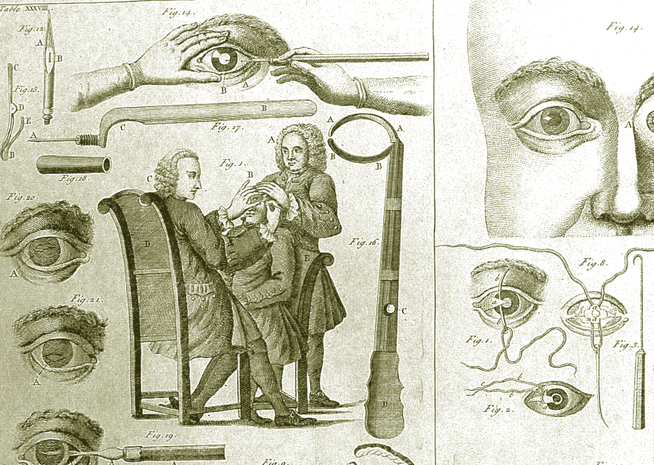 Die Geschichte der Augenheilkunde 1 Cataract History Wikimedia CC