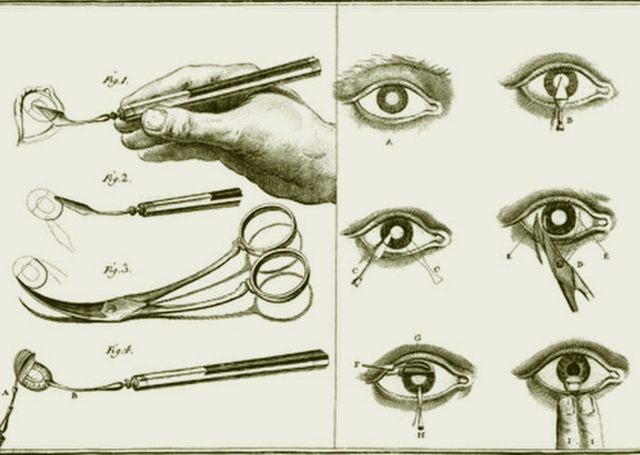 Die Geschichte der Augenheilkunde 12 Wikimedia Cataract surgery